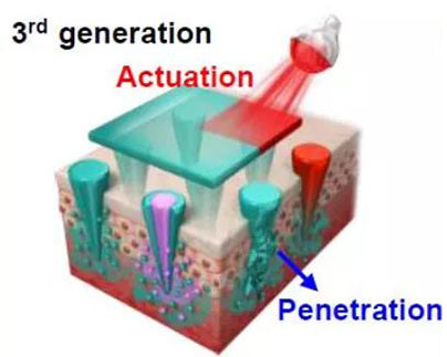 第三代：通过微针介导的皮肤层破坏和微针伴随的各种功能增强药物转运.jpg